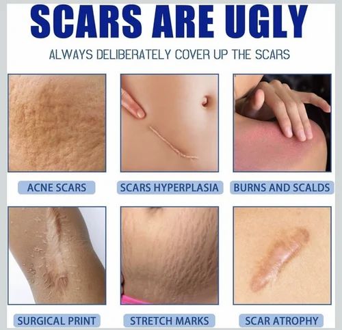 Clinically Proved ☑️ Scar Remover cream